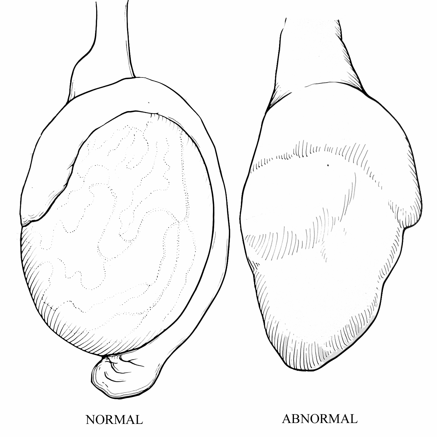 normal vs. abnormal testicle